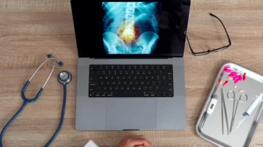 Top view of hand of a woman doctor showing a x-ray of pain in the spine on a laptop. High quality 4k footage