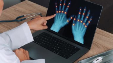 Woman doctor showing a x-ray of hands with pain in the joints on a laptop. Right to left shot. High quality 4k footage