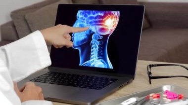 Close up of hand of a woman doctor showing a x-ray of brain on a laptop. Migraine headache concept. Right to left shot. High quality 4k footage