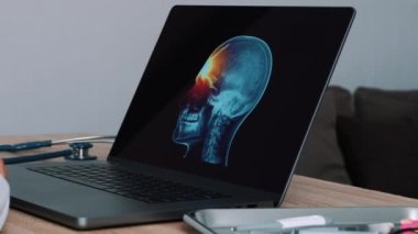 Woman doctor showing a x-ray of skull with pain in the forehead on a laptop. Left to right shot. High quality 4k footage