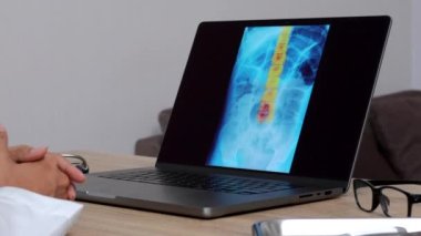 Hand of a woman doctor showing a x-ray of a spine on a laptop. Close up shot. High quality 4k footage