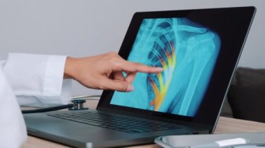 Woman Doctor showing x-ray with pain on the ribs on a laptop. Slow motion. High quality 4k footage