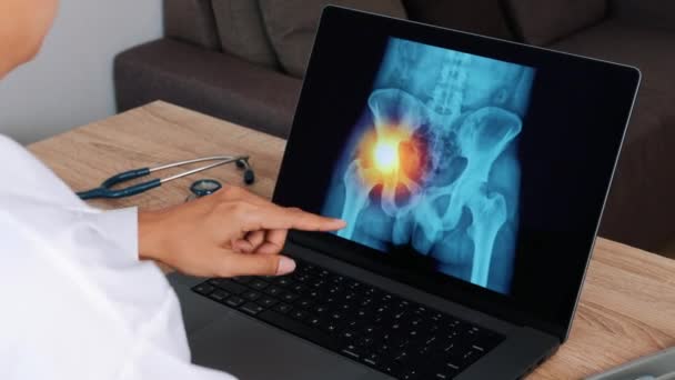 Kvinna Läkare Visar Röntgen Med Smärta Höften Sidan Bärbar Dator — Stockvideo