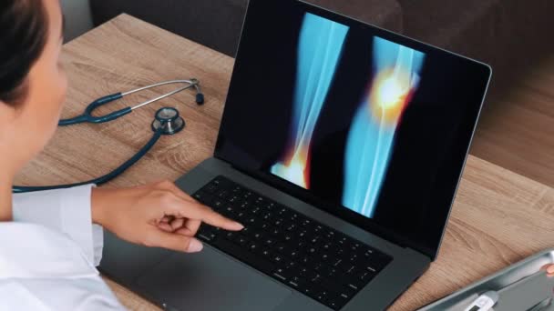Доктор Женщина Показала Рентген Болью Колене Лодыжке Ноутбуке Вид Над — стоковое видео