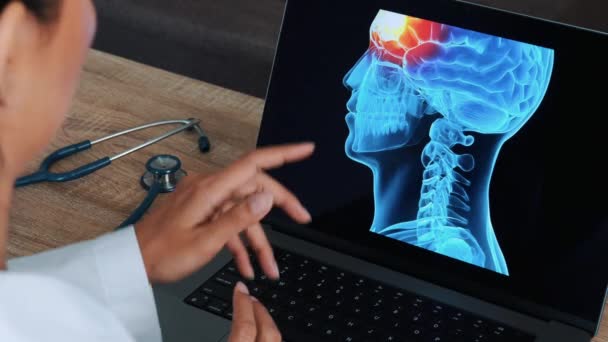 Жінка Лікар Показує Рентген Черепа Болем Мозку Ноутбуці Вид Плече — стокове відео