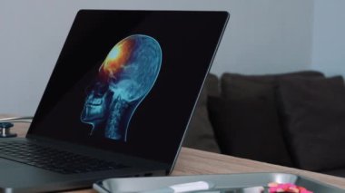 Woman doctor showing a x-ray of skull with pain in the forehead on a laptop. Right to left shot. High quality 4k footage