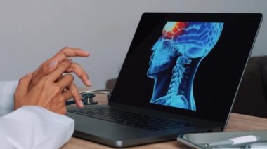 Close up of doctor showing a x-ray of skull with pain in the brain on a laptop. High quality 4k footage