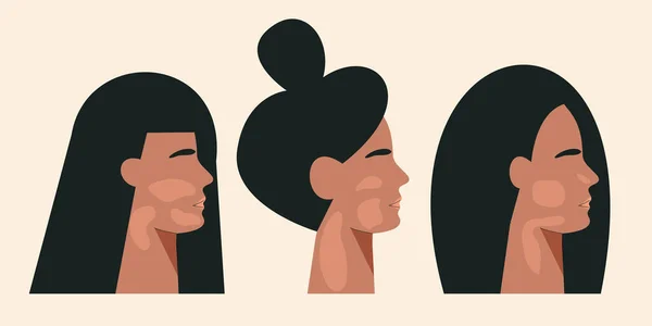 Vitiligo kronik deri pigmentasyon bozukluğu olan kadın silueti. Dünya Vitiligo Günü konsepti. Cilt hastalığı olan bir kızın portresi. Farklı bir güzellik. Düz vektör çizimi izole edilmiş beyaz arkaplan — Stok Vektör