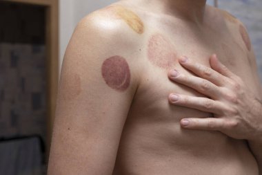 Çürük, vakum kutusundan alınan deri kalıntısı. İnsanın omuzlarında vakum tedavisi. Tedavi izleri.