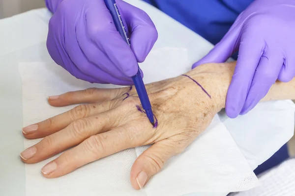 Plastischer Chirurg markiert Frauenhand für Operation — Stockfoto