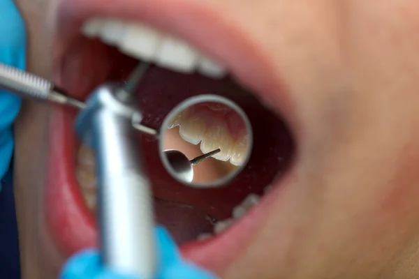 Perforación dental —  Fotos de Stock
