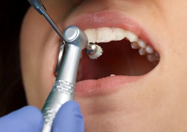 Professional dental brushing — Stock Photo, Image