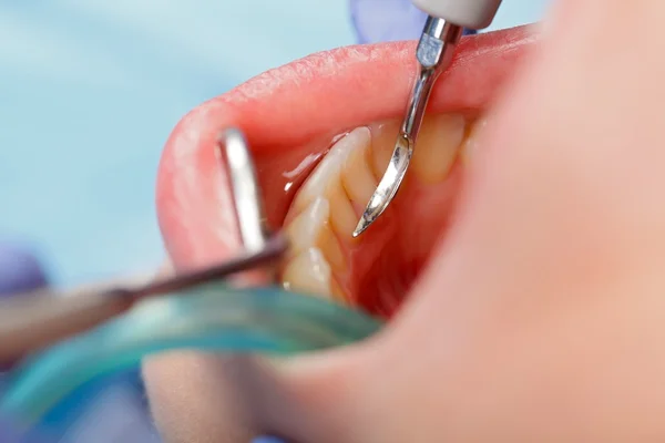 Eliminación del cálculo dental — Foto de Stock