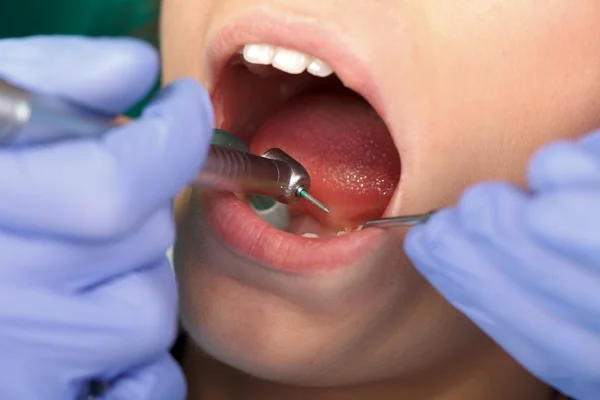 Perfuração dentária — Fotografia de Stock