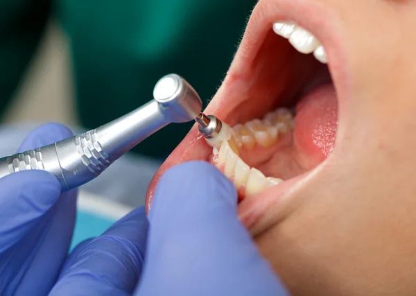Cepillado dental profesional —  Fotos de Stock