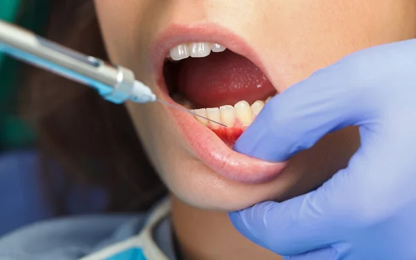 Anestesia dental — Foto de Stock