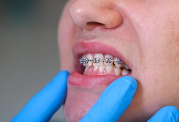 Bretelle dentali — Foto Stock