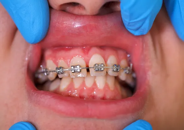 Dental braces — Stock Photo, Image