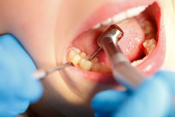 Dental drilling — Stock Photo, Image