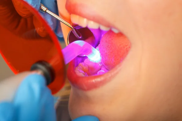 Dental obturation — Stock Photo, Image