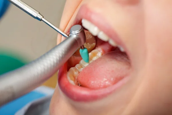 Dental obturation — Stock Photo, Image