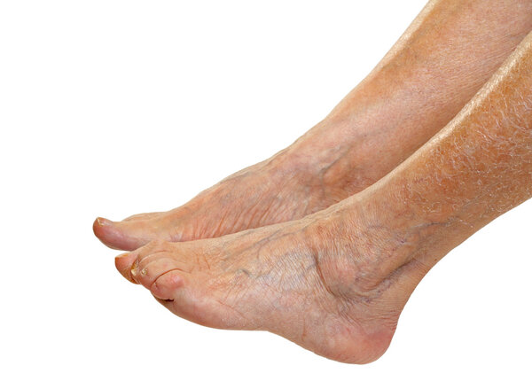 Elderly feet