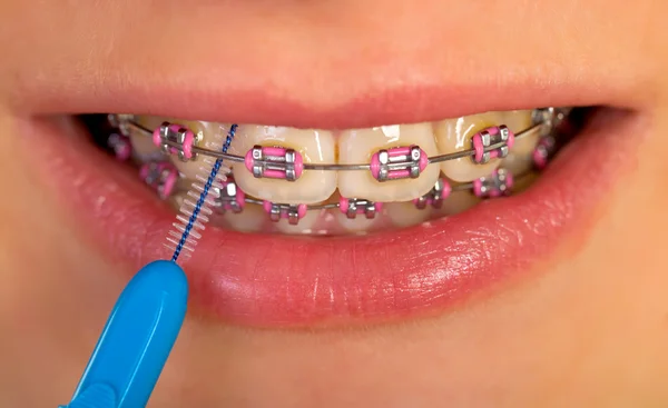 Cepillado interdental — Foto de Stock