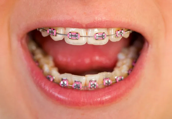 Pink braces — Stock Photo, Image