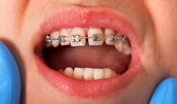 Dental braces — Stock Photo, Image