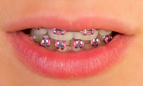 Pink braces — Stock Photo, Image