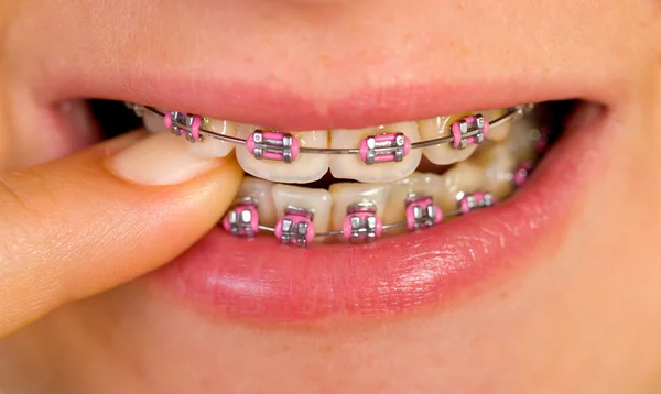 Pink braces — Stock Photo, Image