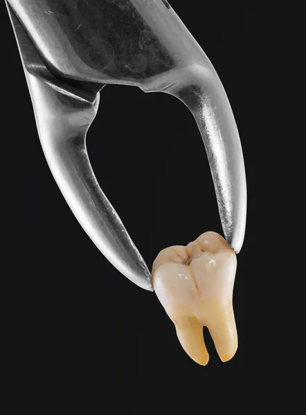 Αφαίρεση δοντιού — Φωτογραφία Αρχείου