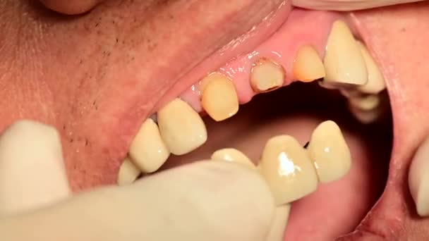 Close Shot Installing Ceramic Crown Dental Veneers Incisor — Stock Video