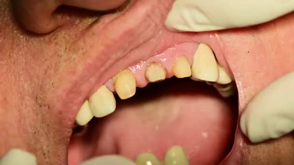 Detailní Záběr Zubního Porcelánu Instalace Cementování — Stock video