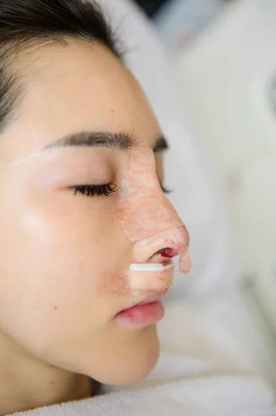 Side view of woman with bandage on her nose after rhinoplasty