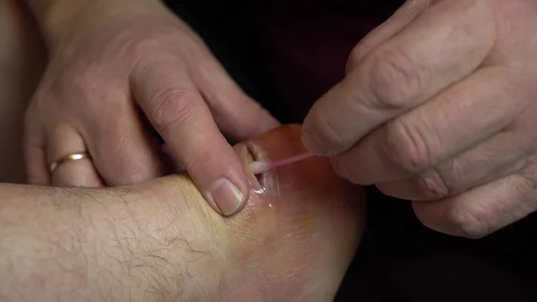 Trattamento delle ferite da suppurazione con un batuffolo di cotone. Incisione chirurgica dell'articolazione della caviglia per infiammazione. — Foto Stock