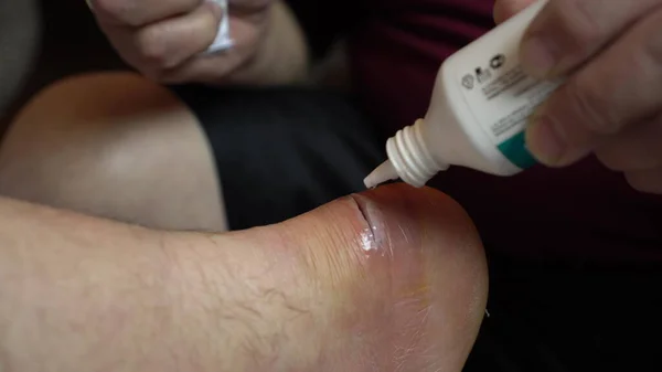 Trattare una ferita alla gamba con un antisettico. Incisione operatoria della caviglia a causa di infiammazione. — Foto Stock
