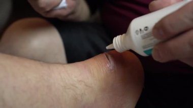 Bacağındaki yarayı antiseptikle tedavi ediyor. İnflamasyona bağlı olarak bileğinde ameliyat kesiği var..
