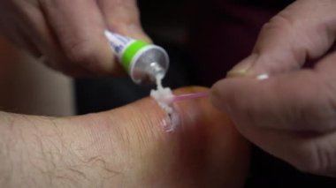 Bacağındaki bir yarayı iyileştirmek için merhem sürme. İltihap için ayak bileğinde cerrahi kesik..