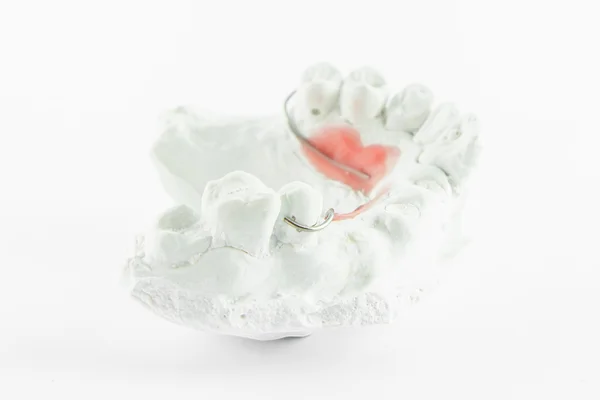 Wire in Plaster denture model — Stock Photo, Image