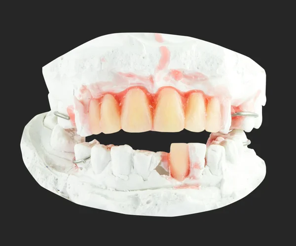 Upper and lower denture teeth with wax model isolate — Stock Photo, Image