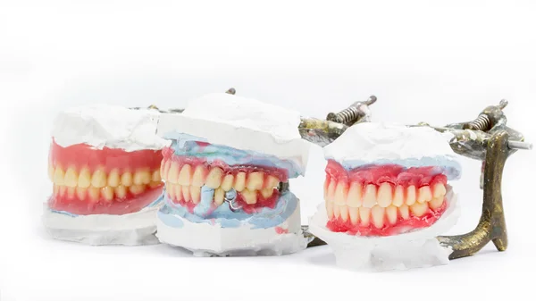 Dentiera in cera, modelli dentali che mostrano diversi tipi — Foto Stock