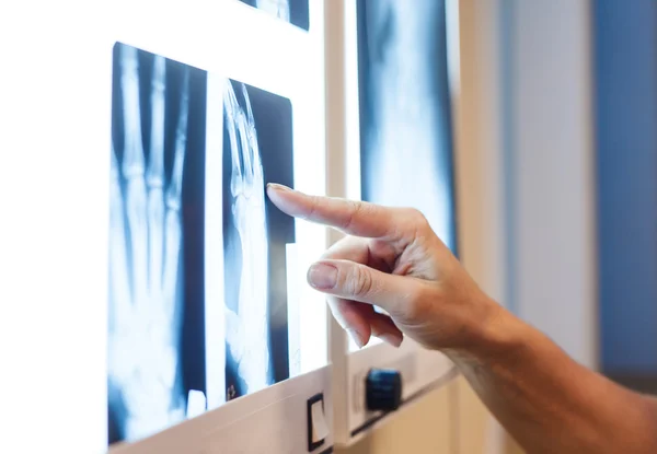 Hand wijzend op x-ray beelden — Stockfoto