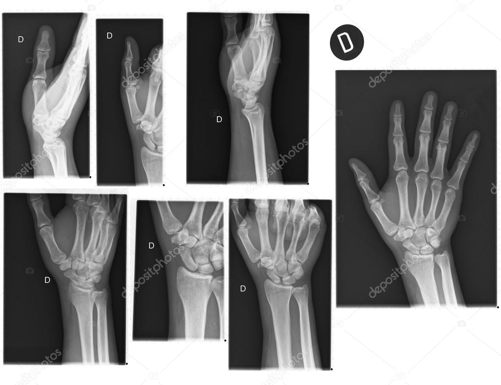 Real X-rays of the Hand and wrist.