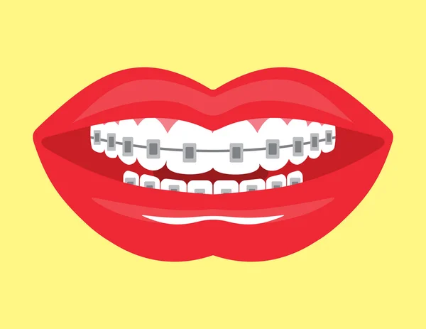 Hermosa sonrisa con frenos estéticos — Vector de stock