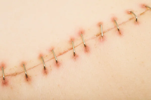 Metal staples (satures) in a scar left — Stock Photo, Image