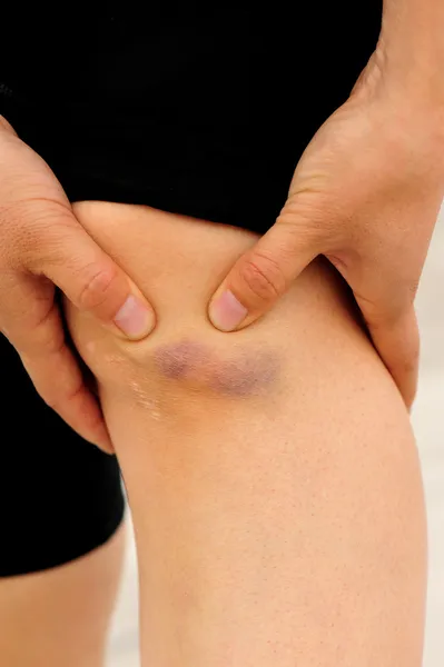 Deportes lesionados rodilla — Foto de Stock