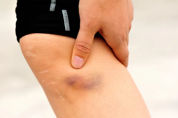 Injured knee — Stock Photo, Image