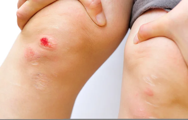 Поврежденное колено — стоковое фото
