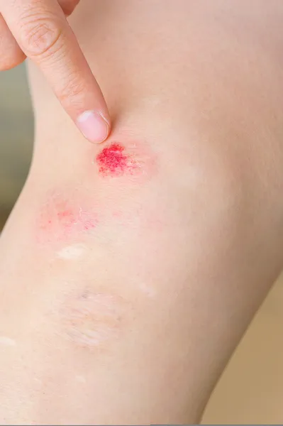 Поврежденное колено — стоковое фото